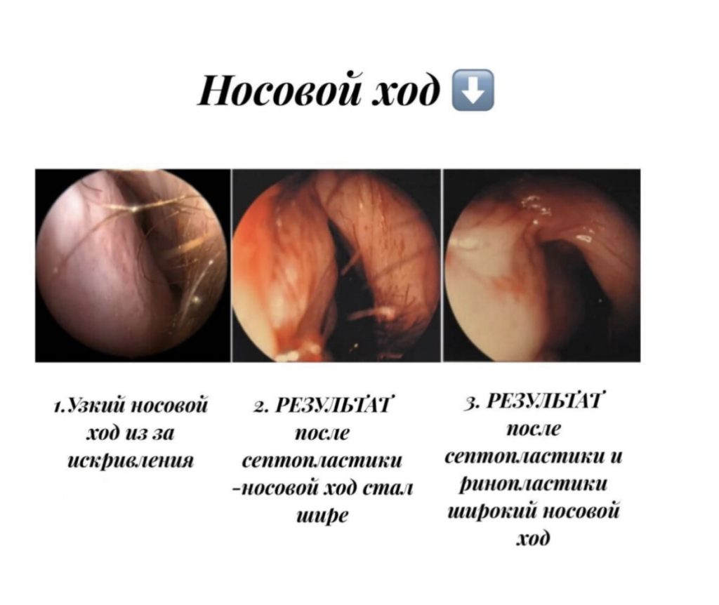 Искривление носовой перегородки: как исправить и какие результаты ждать